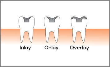 Dental Restorations - Inlays and Onlays