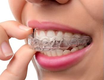 Invisalign Invisible Braces for Crooked Teeth