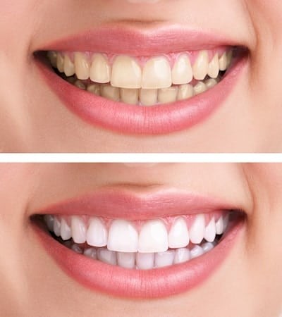 Steps Required for Dentist Office Teeth Whitening Procedure