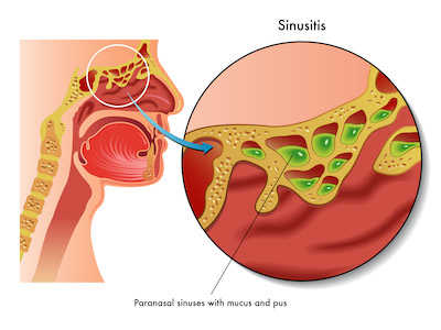 Illustration of sinusitis