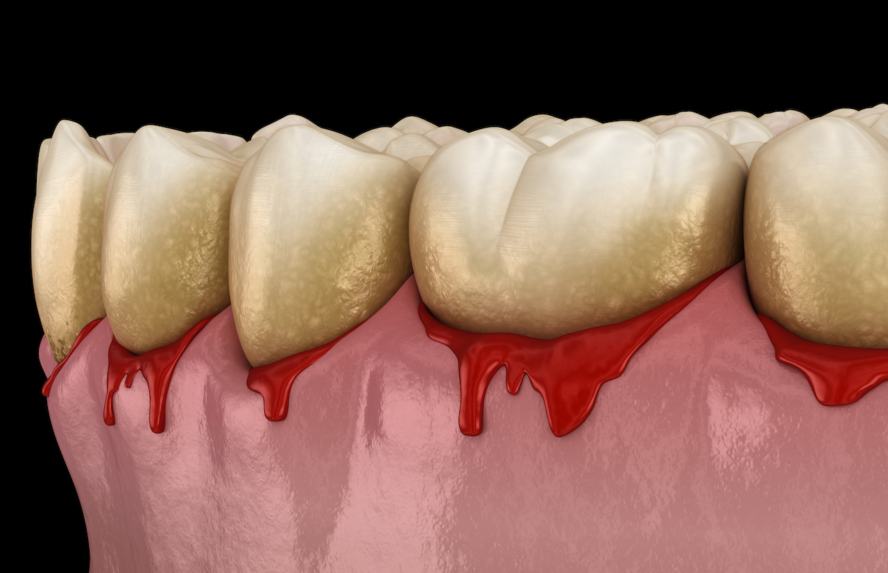 Illustration of bleeding gums.