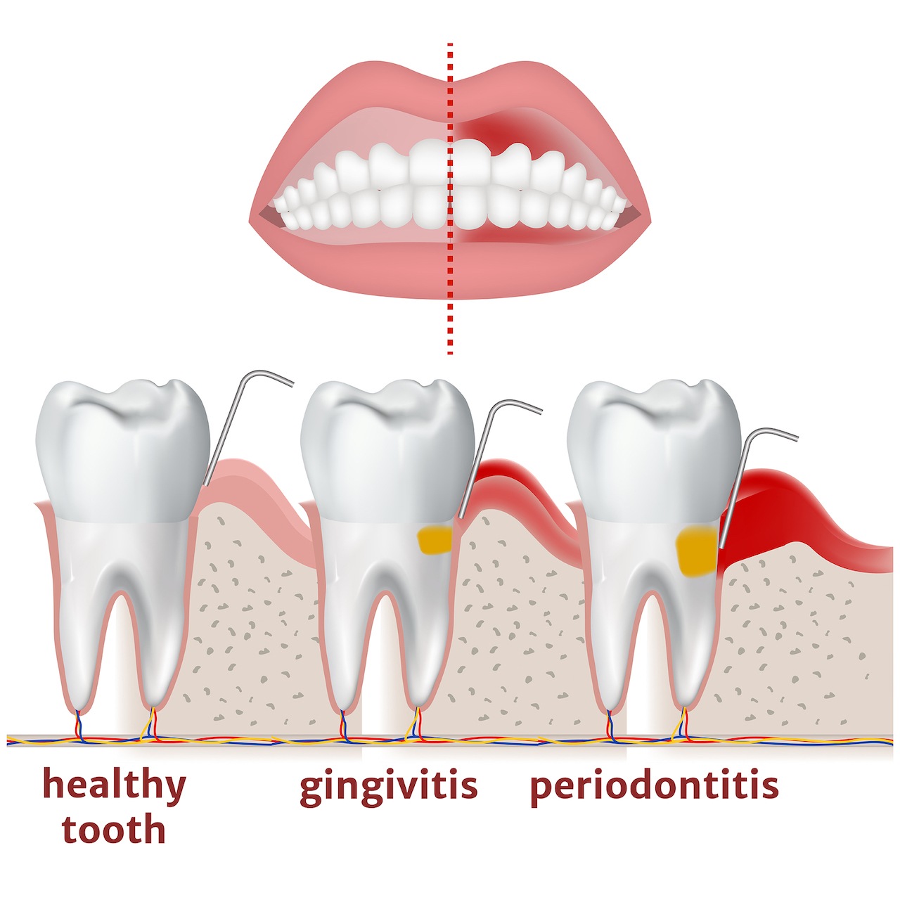 How gingivitis progress to periodontitis.