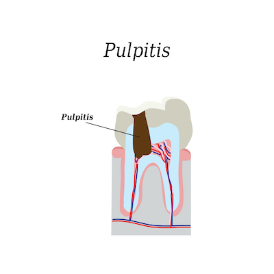 Illustration of Pulpitis