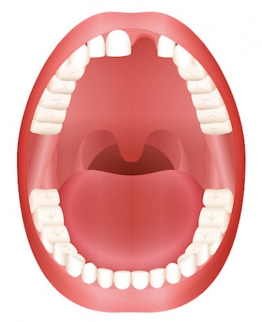 Tooth Loss Illustration
