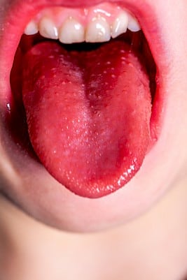 scarlet fever red tongue