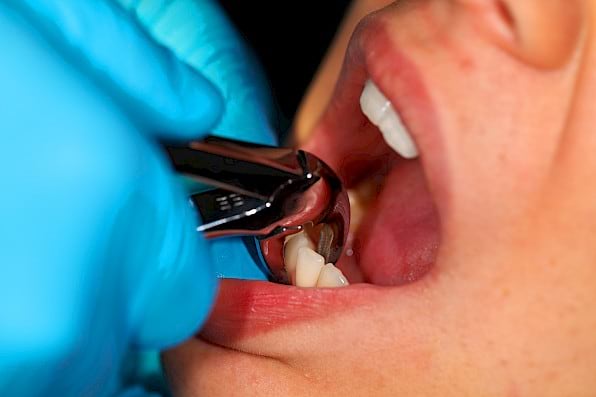 Tooth extraction.