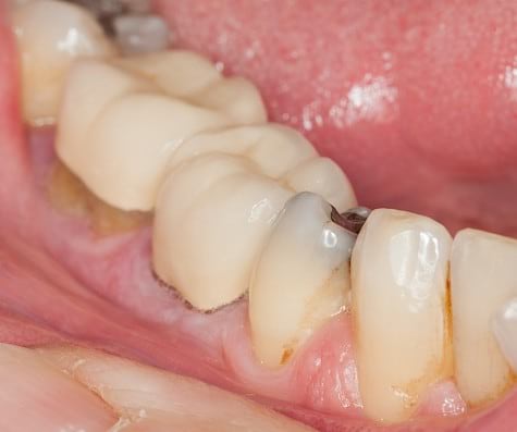 Discolored teeth with cavities.