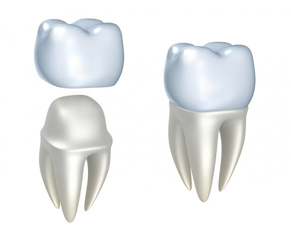 Dental crowns.