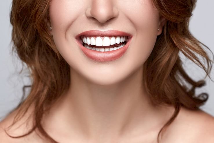 Woman smiling with veneers.