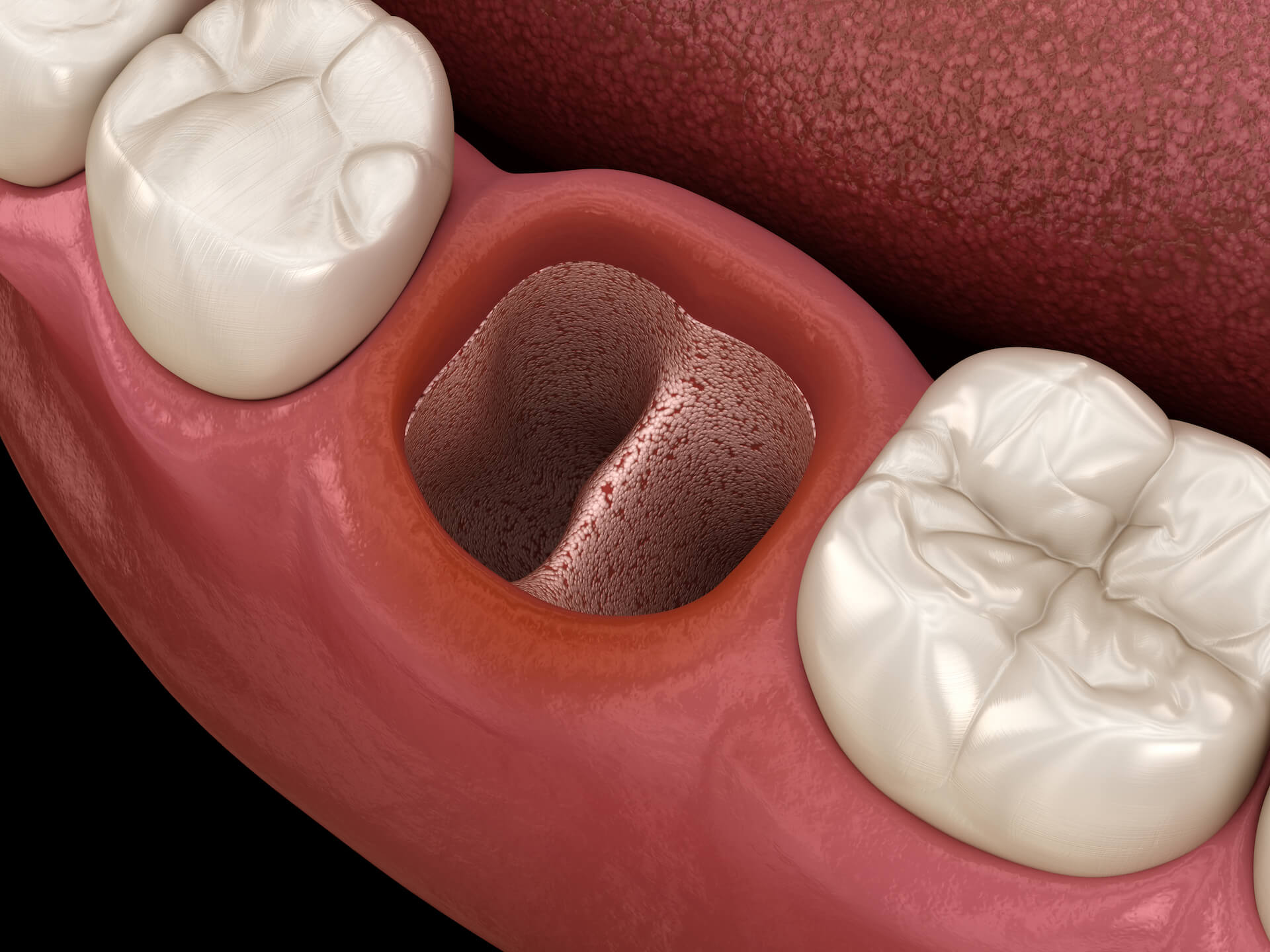 Dry socket after tooth extraction.