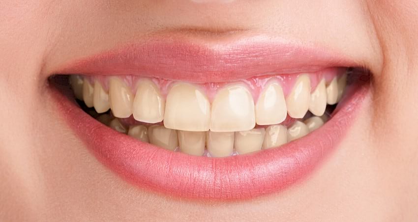 Stained teeth that requires professional dental cleaning.