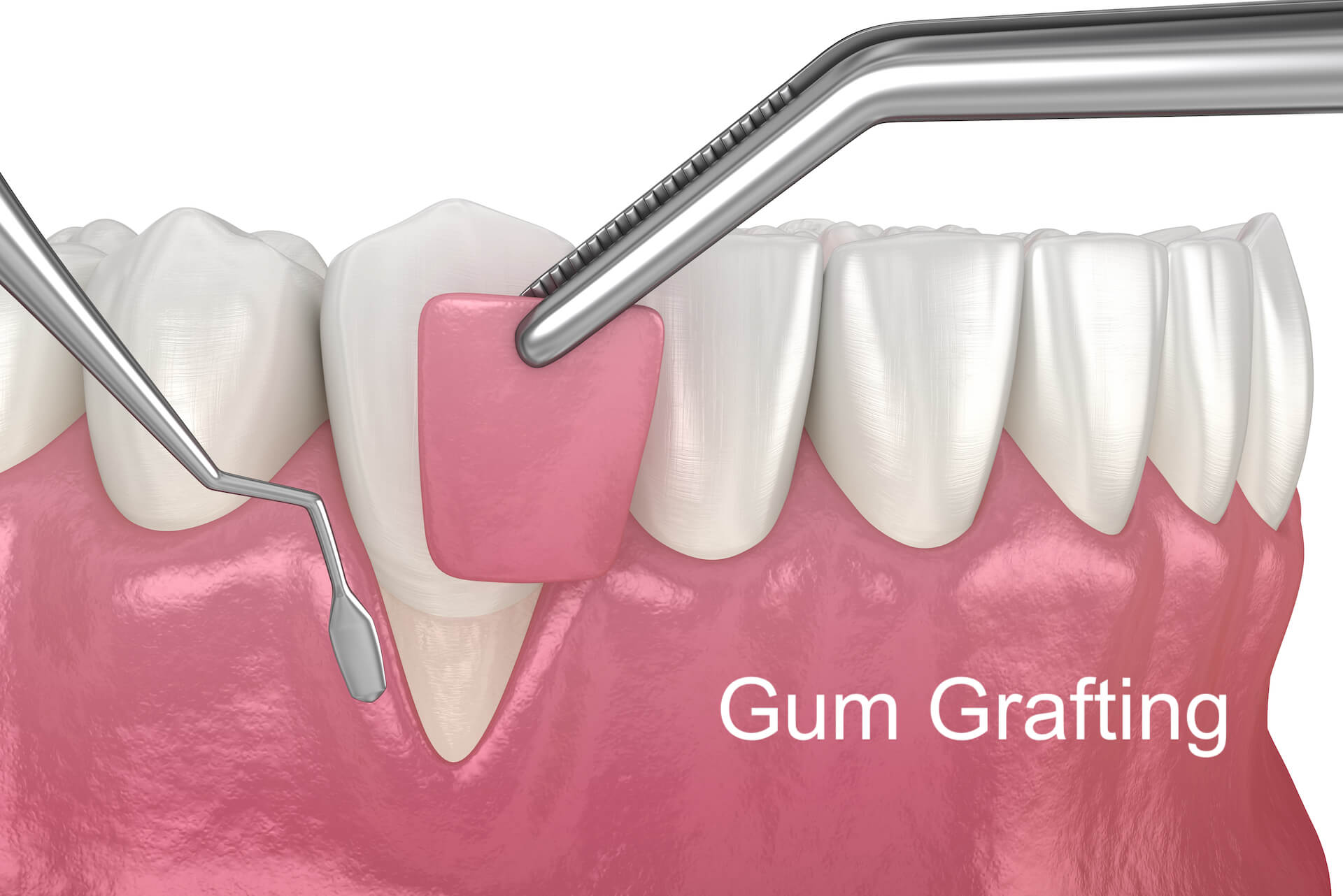 Gum grafting illustration.