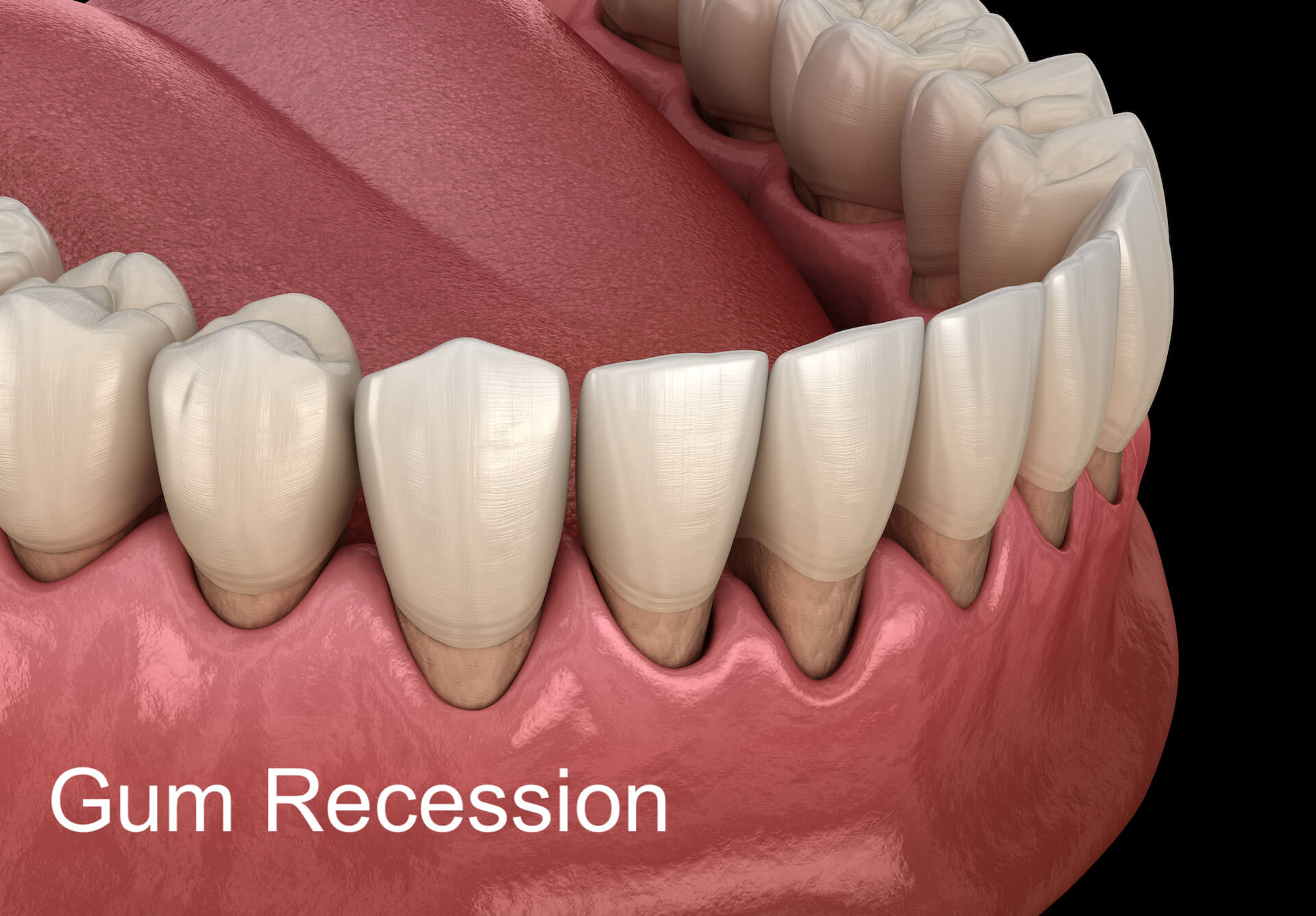 Gum recession illustration.