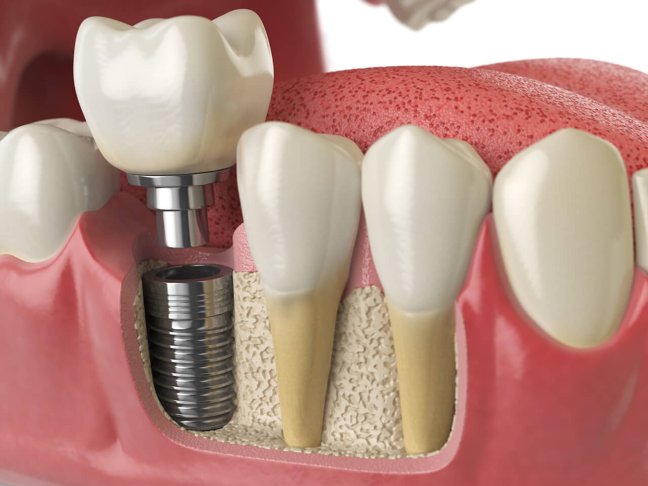 Dental implant, a small titanium post inserted into the jawbone to replace the root of a missing tooth, with an abutment and crown attached on top.