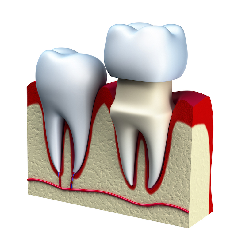 Dental crown, a tooth-shaped cap used to restore damaged teeth and improve oral health.