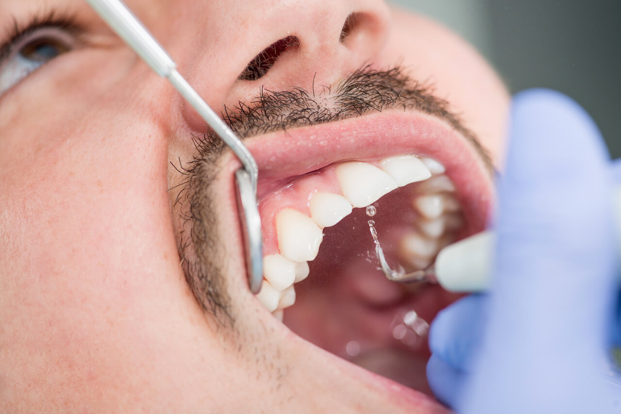 Close-up of a dental cleaning.