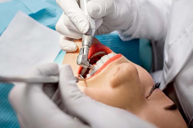 Full mouth debridement cleaning - removing plaque and tartar for improved oral hygiene.