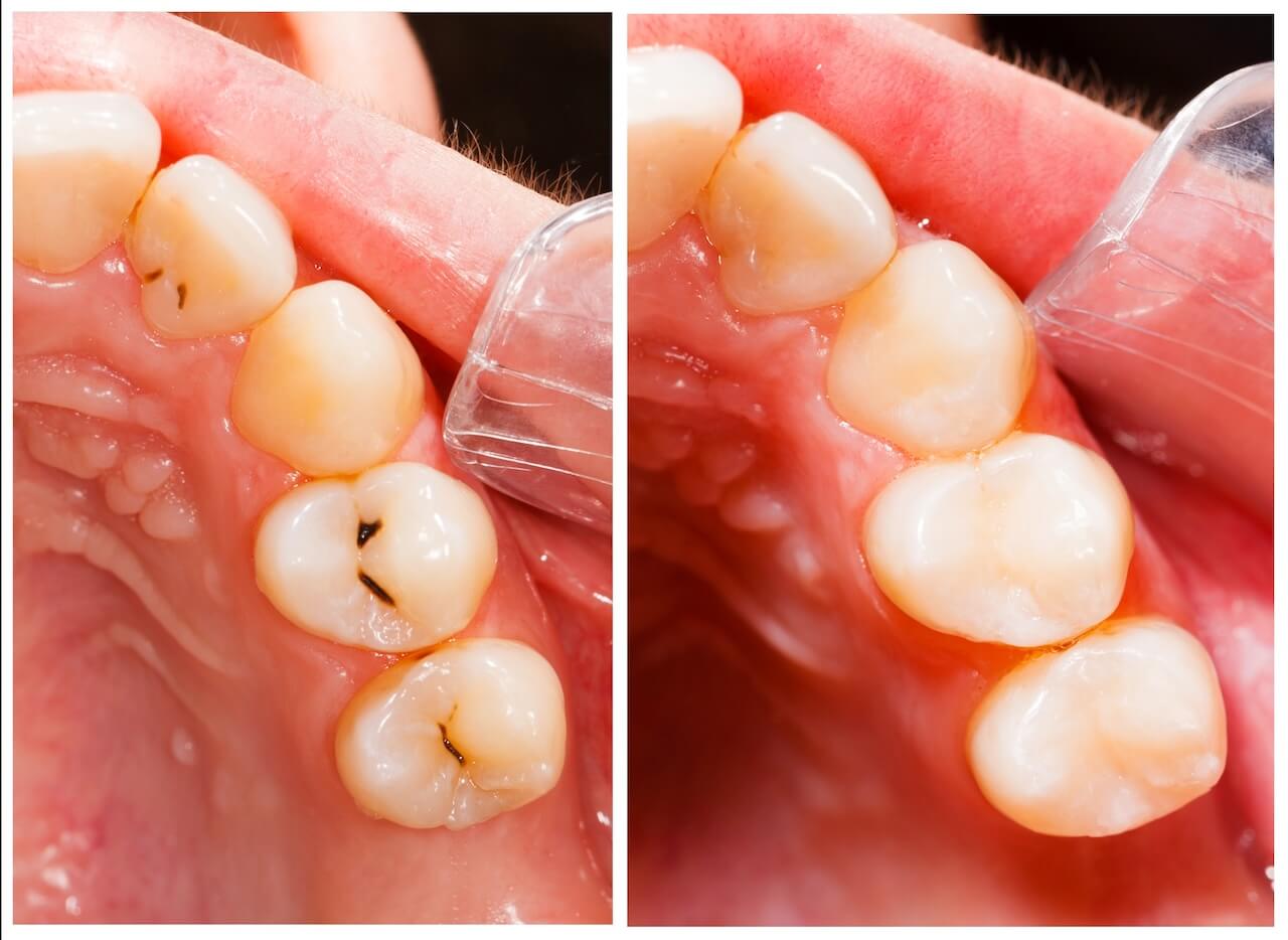 Tooth cavity solution.