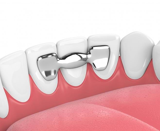 Maryland dental bridge to solve missing teeth problem.