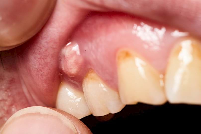 Dental abscess - one cause of severe tooth pain.