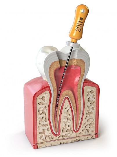 Root canal procedure.