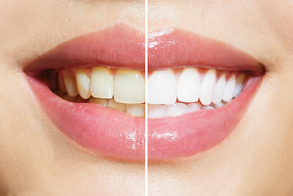 Close-up comparison of tooth shade before and after professional teeth whitening
