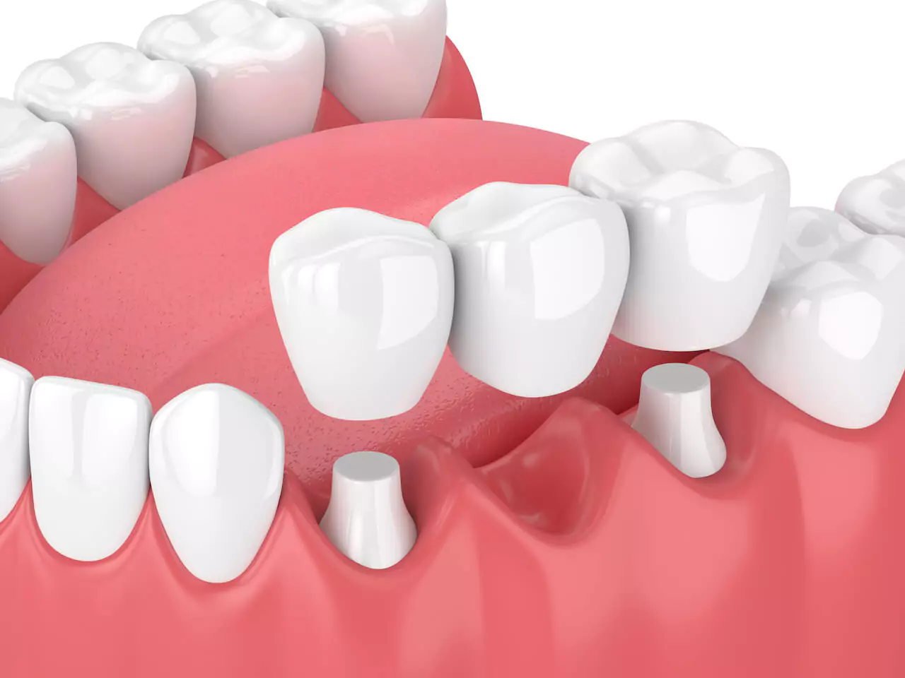 dental-bridge-post